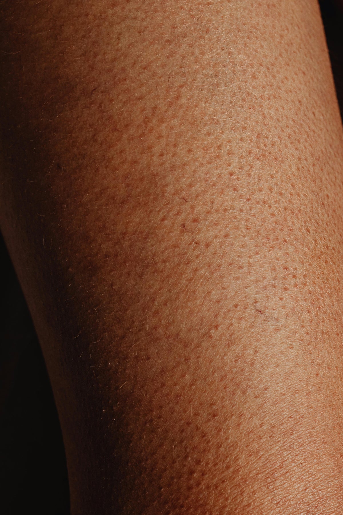 What is KP — and what causes it?